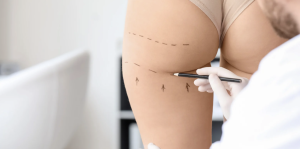 Free Quote for Liposuction in Herndon or Reston VA